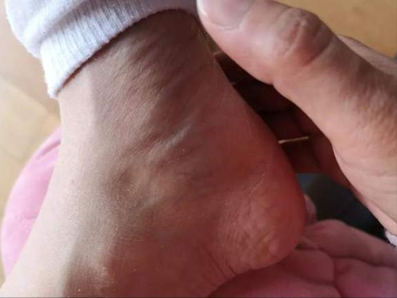 咳嗽药是不是容易伤肝,止咳药会成瘾吗