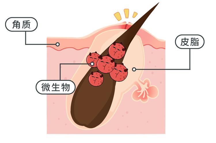 不同部位长痘痘的原因及解决方法,不同地方长痘痘的原因和改善方法