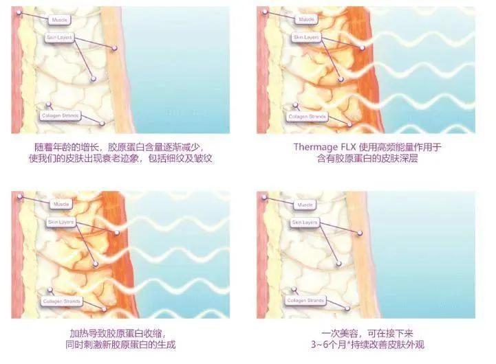 正规热玛吉和山寨的区别,热玛吉造假