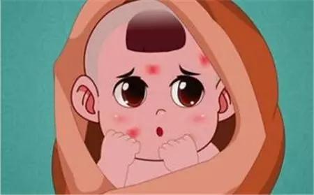血管瘤破了结痂,宝宝血管瘤破溃结痂好了