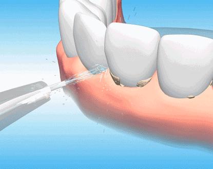 牙龈肿痛牙龈出血是否是病,为什么一上火牙龈就出血