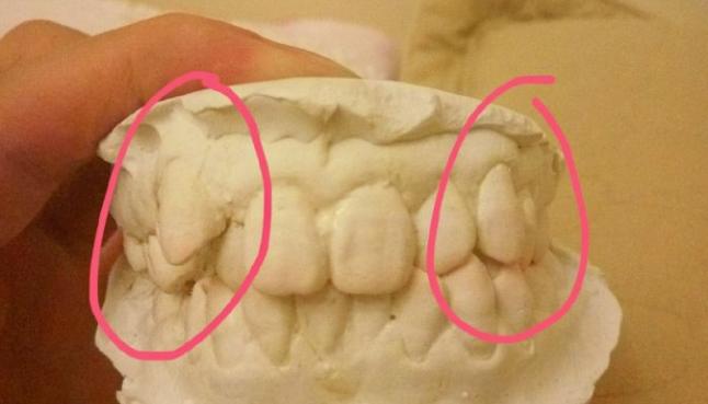 戴全牙套,初学者戴牙套的感受