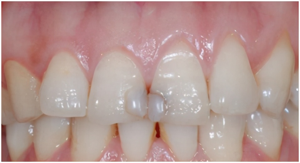 600块钱一颗牙怎么样,600块一颗牙贵吗