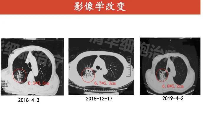 肺癌晚期活不了多久的症状,肺癌晚期生命只剩下六个月