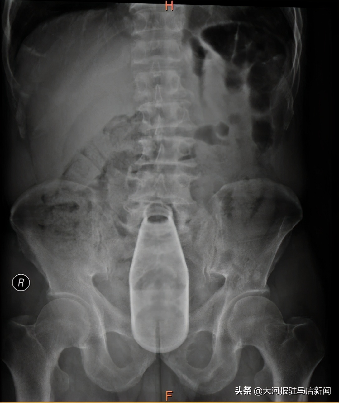 难以启齿的病后续,难以启齿的就医后续