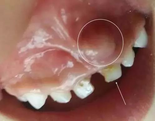 牙龈反复鼓包流脓是牙齿坏了吗,一上火牙龈就鼓包