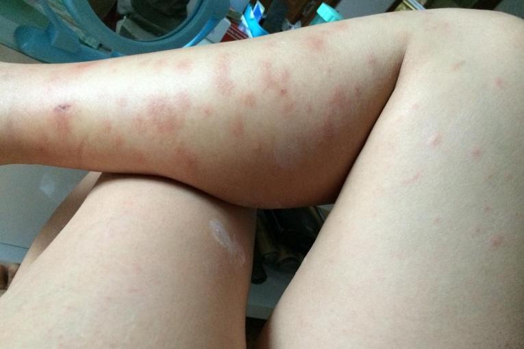 艾滋病患者皮肤会出现什么症状,皮肤瘙痒变硬脱皮是艾滋病症状