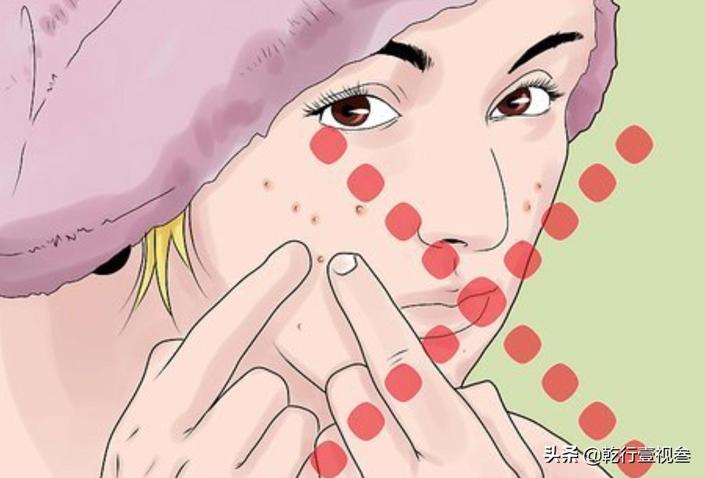 如何预防和祛除青春痘(上)