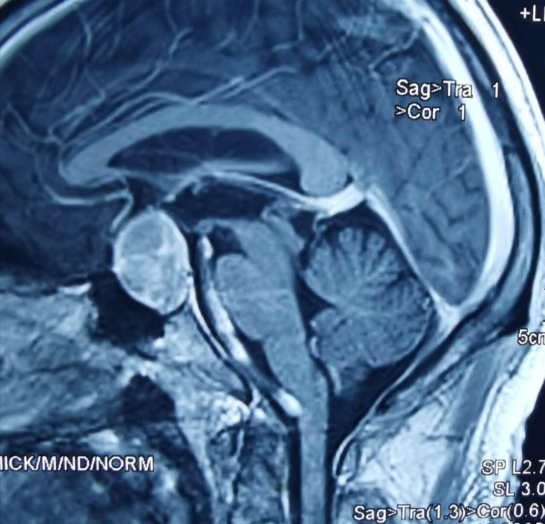 抽血泌乳素偏高一倍怎么办,抽血检查垂体泌乳素是什么