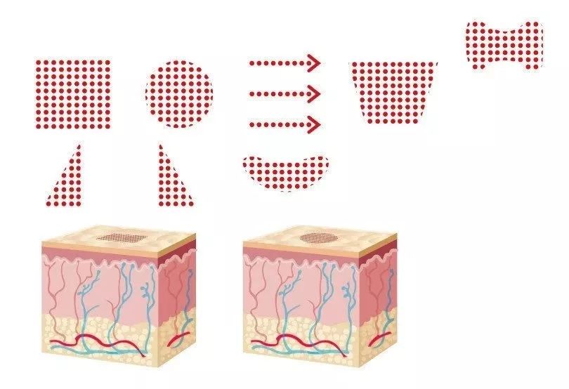 点阵激光真的有明显效果,点阵激光多久能退红恢复正常皮肤