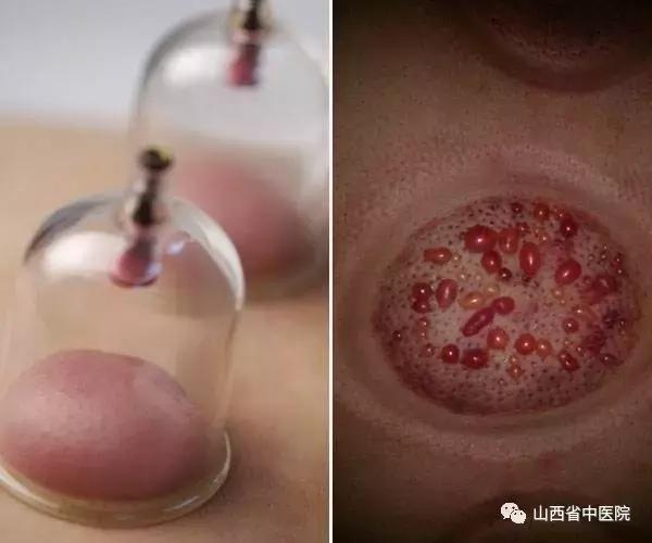 针灸拔罐后注意事项和禁忌症,真空拔罐注意事项可以先用精油吗