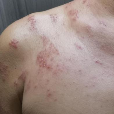 遇到带状疱疹病人怎么防护,得了带状疱疹吃什么药最好