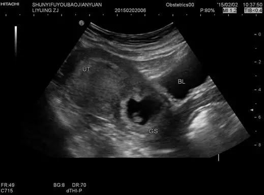 阴式超声怎么做,腹式超声和阴式超声