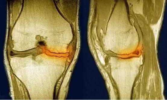 半月板自查方法,半月板最新诊疗指南