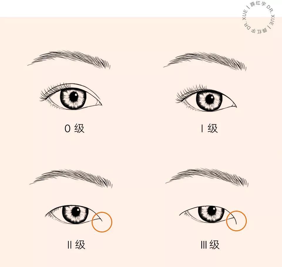 从美术角度谈眯眯眼,开内眼角传统术式