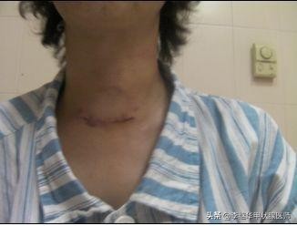 甲状腺结节多发伴钙化建议随访,甲状腺结节4b可以随访观察吗