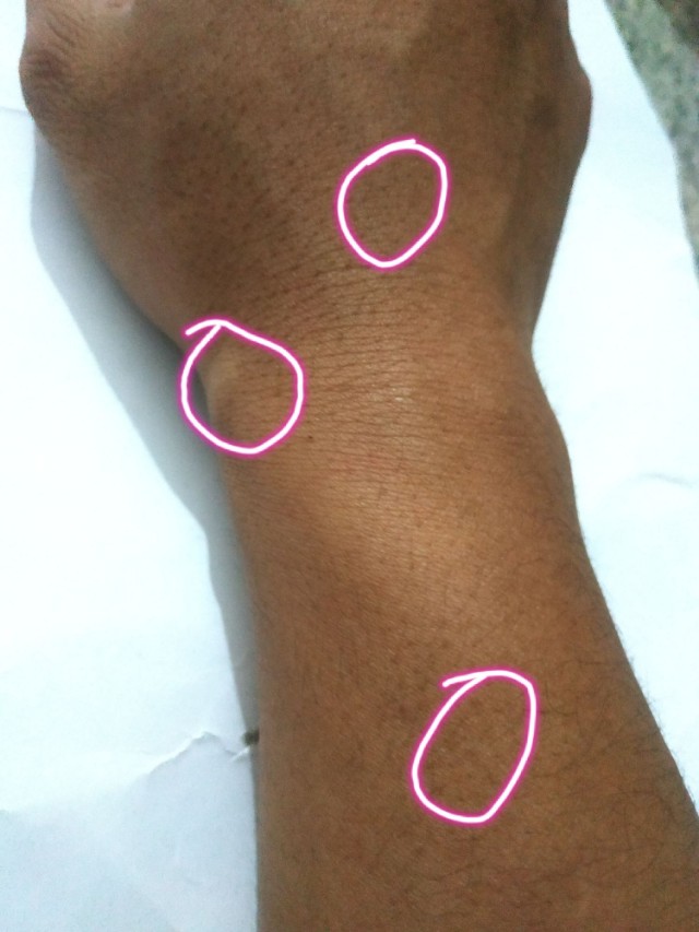 手受伤后，附近血管感觉有些堵塞，摸起来有个小包，这是怎么回事