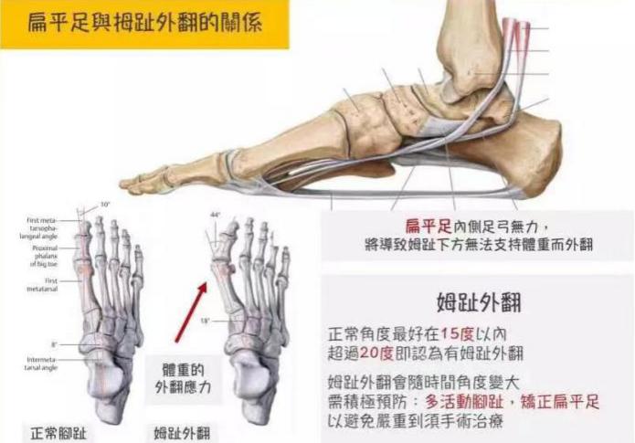 拇指外翻畸形的治疗方法,小孩脚拇趾外翻矫正方法