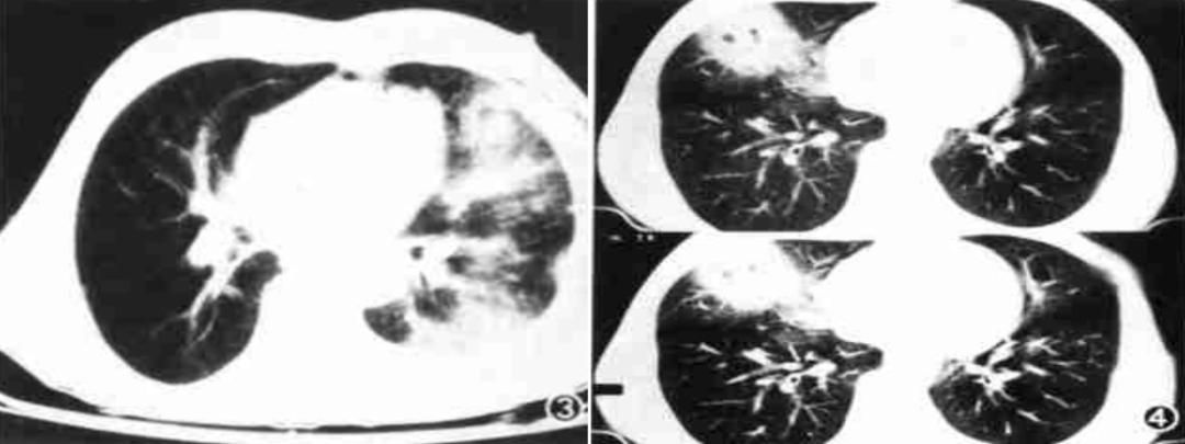 56岁男性发现双肺,56岁男性发现双肺数百个结节