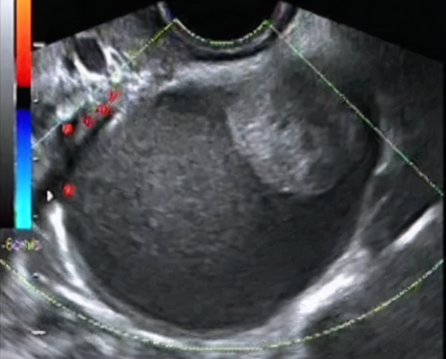 体检发现卵巢囊肿后面复查没有了,月经前体检卵巢囊肿