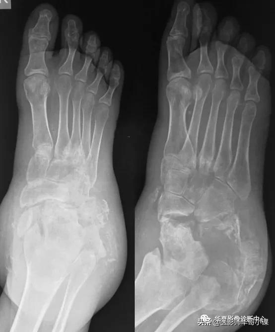 神经性脊椎炎,神经性风湿病