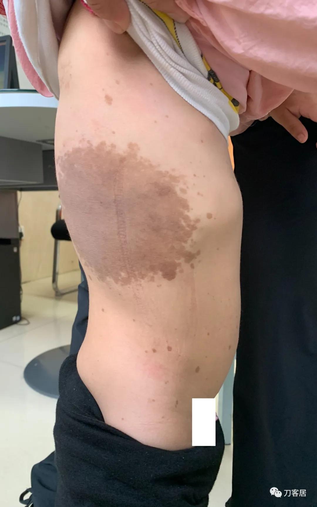 我的门诊病历：家族性神经纤维瘤病性脊柱侧凸