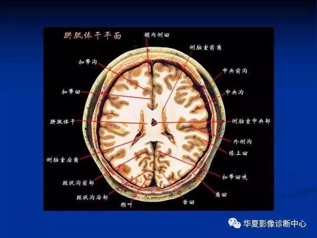 电子版头颅ct与mri断层解剖,头颅mri血管解剖与分段详解