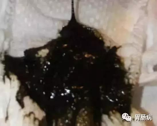 直肠癌误诊为痔疮5年,直肠癌与痔疮便血区别在哪些