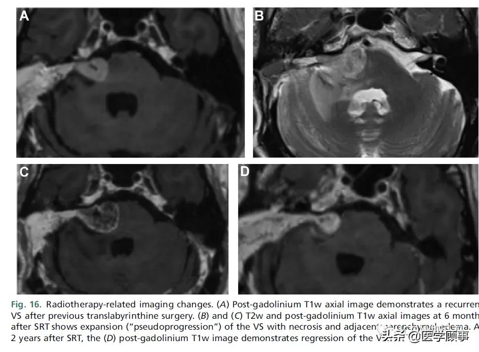 「综述」前庭神经鞘瘤的成像：诊断、监测、和治疗计划