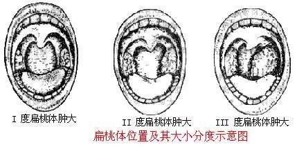 扁桃体容易发炎可以割掉吗,扁桃体老是发炎怎么彻底根治