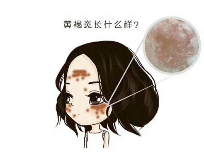欧阳医生带你了解*褐斑黄**的成因及预防