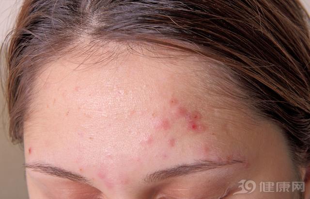 脸上的螨虫洞会愈合么,脸上螨虫多了会出油