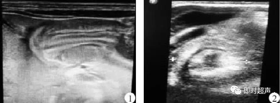 小儿消化道急症超声
