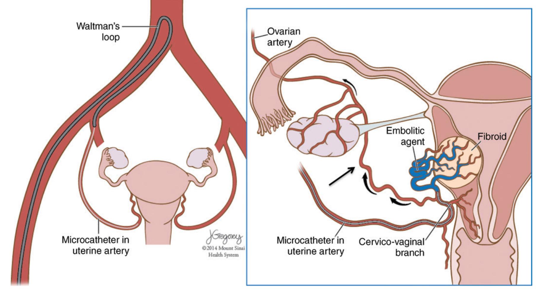 子宫肌瘤什么情况适合用介入栓塞,子宫肌瘤能做栓塞介入吗