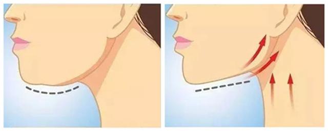 线雕和玻尿酸筋膜提升有什么区别,玻尿酸线雕是什么样子