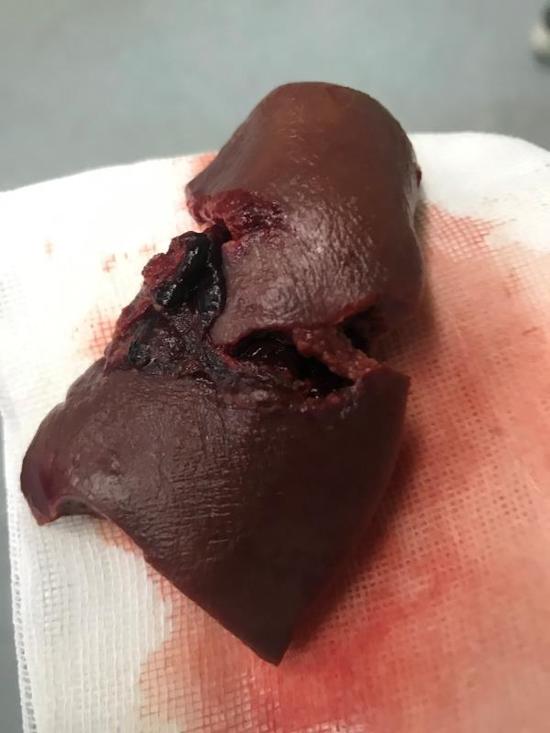 儿童脾破裂怎么办,脾脏破裂保守治疗还是切除