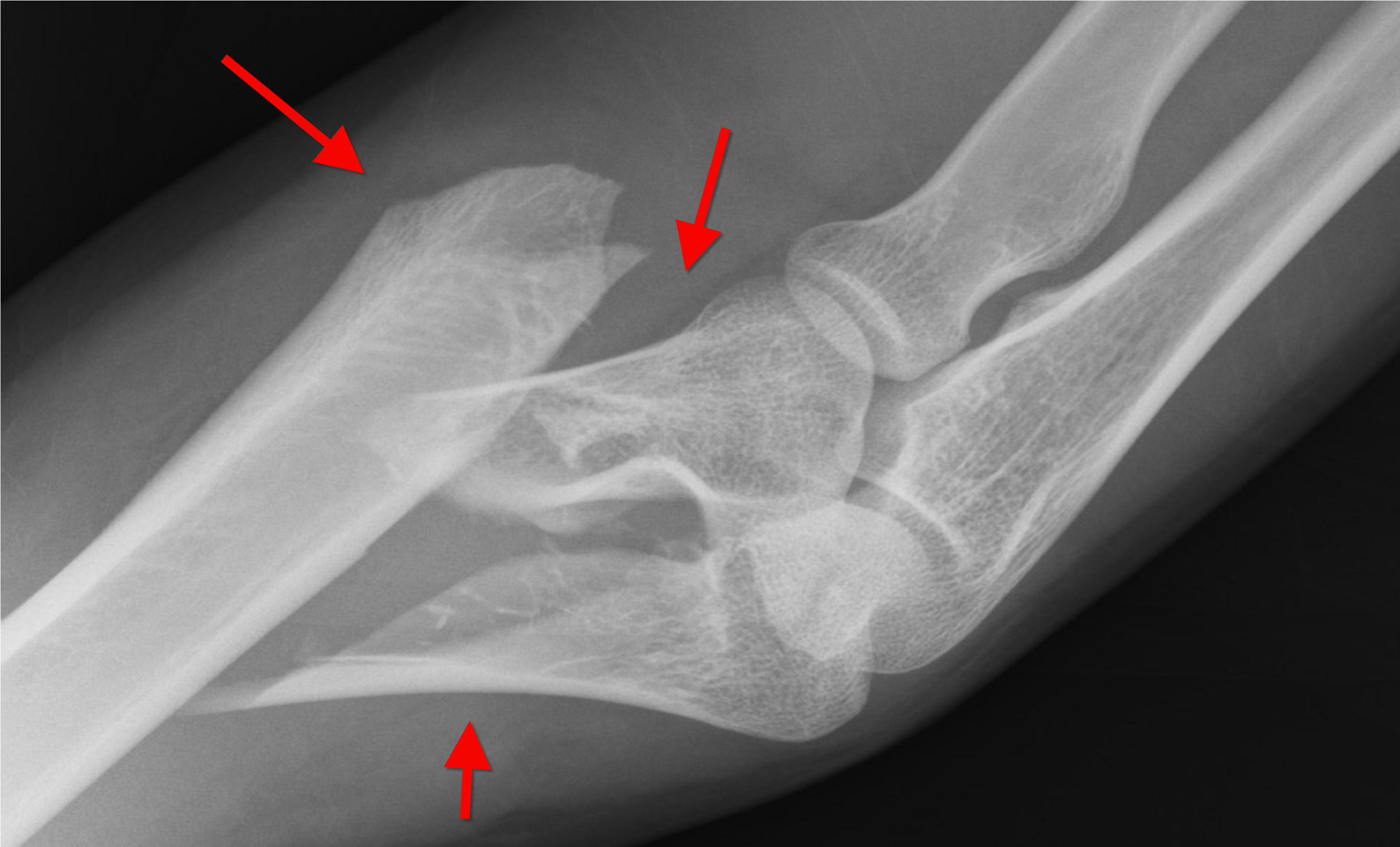 骨折筋伤哪个更容易恢复,骨折后伤筋动骨怎么恢复
