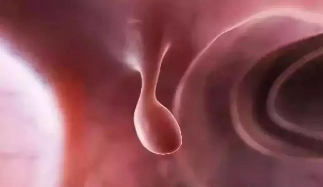 我叫“息肉”，很容易变癌，但是我最怕艾灸