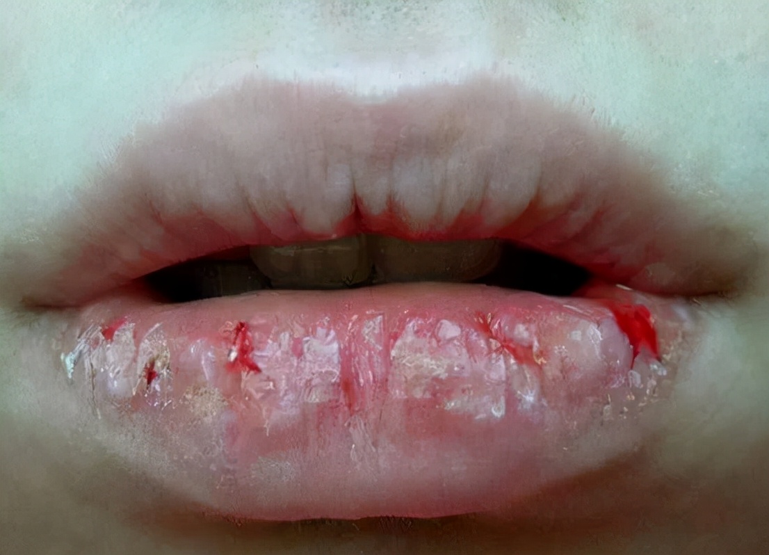 嘴唇脱皮干裂无法涂口红,嘴唇脱皮不干燥是什么原因引起的