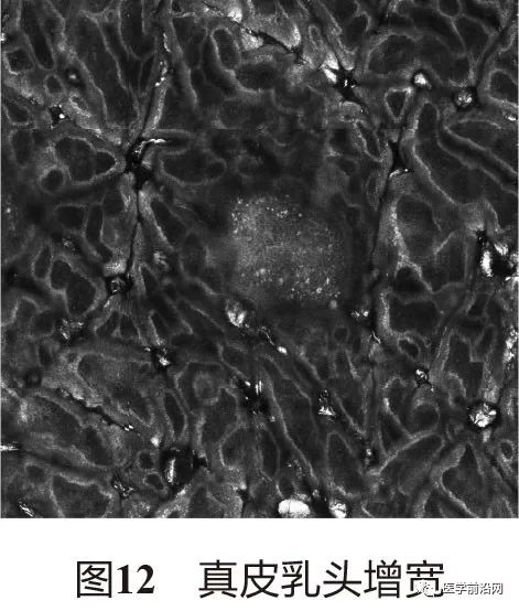 炎症性皮肤病反射式共聚焦显微镜诊断特征专家共识全文发布