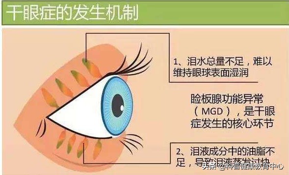 用什么方法治干眼症最好,怎样治疗干眼症好得快