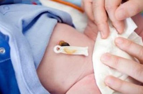 新生儿脐疝怎么处理比较好,新生儿脐疝怎么治疗好得快