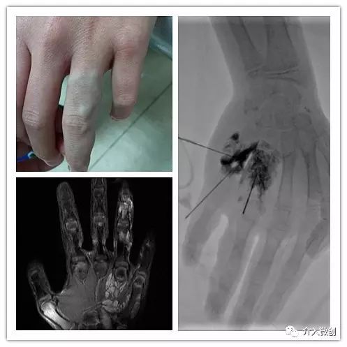 淋巴管畸形硬化治疗费用,静脉畸形硬化的最佳治疗方法