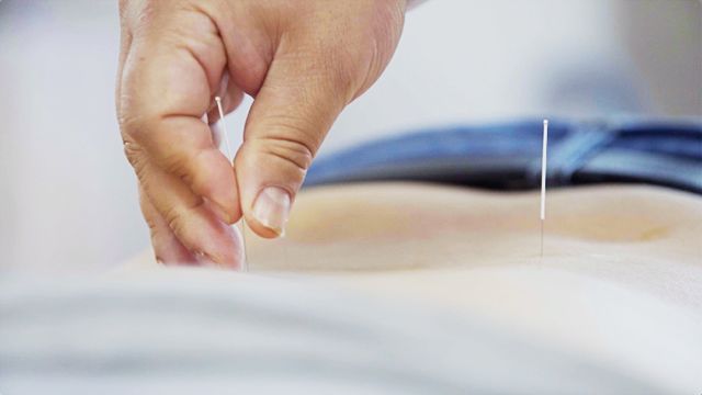 中医神奇的针灸术,中医神奇的针灸秘术