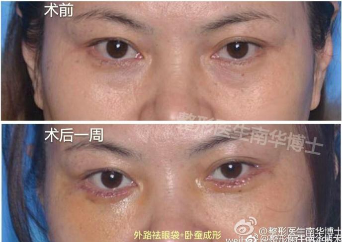 眼袋去除脂肪手术的3d演示,眼袋手术怎样快速消除淤血