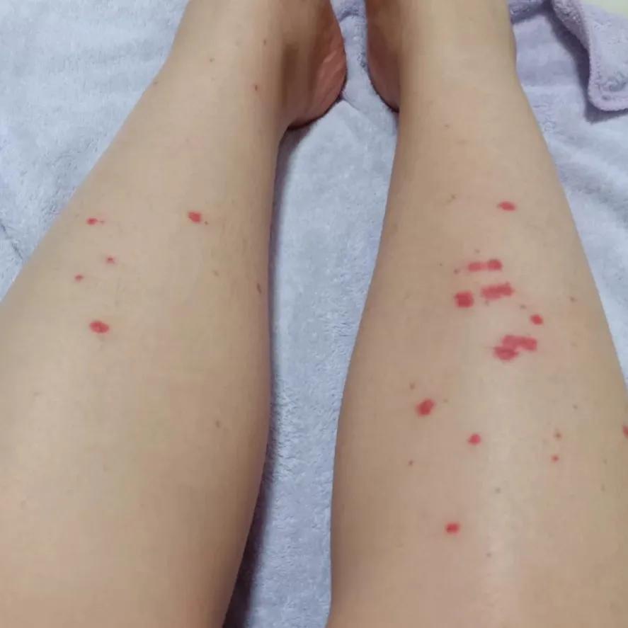 糖尿病人下肢出现出血点,下肢细小出血点什么样子