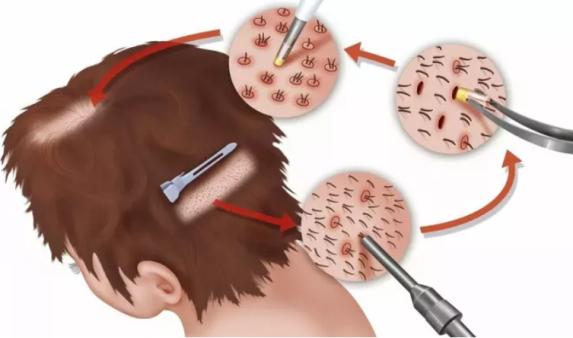 植发七天清理血痂后表面有水珠,植发清理血痂最好的方法