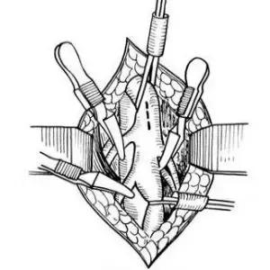 小腿血栓皮肤溃烂创面怎么处理,皮肤血管坏死怎么回事