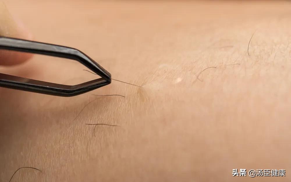 脱毛仪脱毛和激光脱毛哪个好,脱毛仪脱毛方案