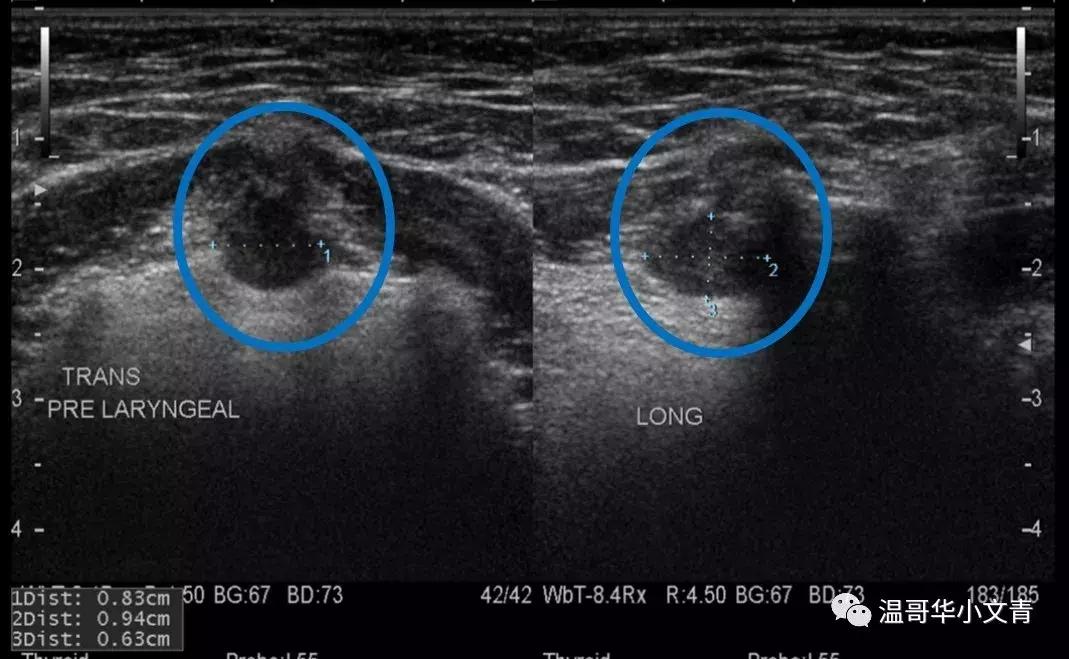 甲状腺癌治疗最好的医院排名,中药治疗甲状腺癌的有效方法